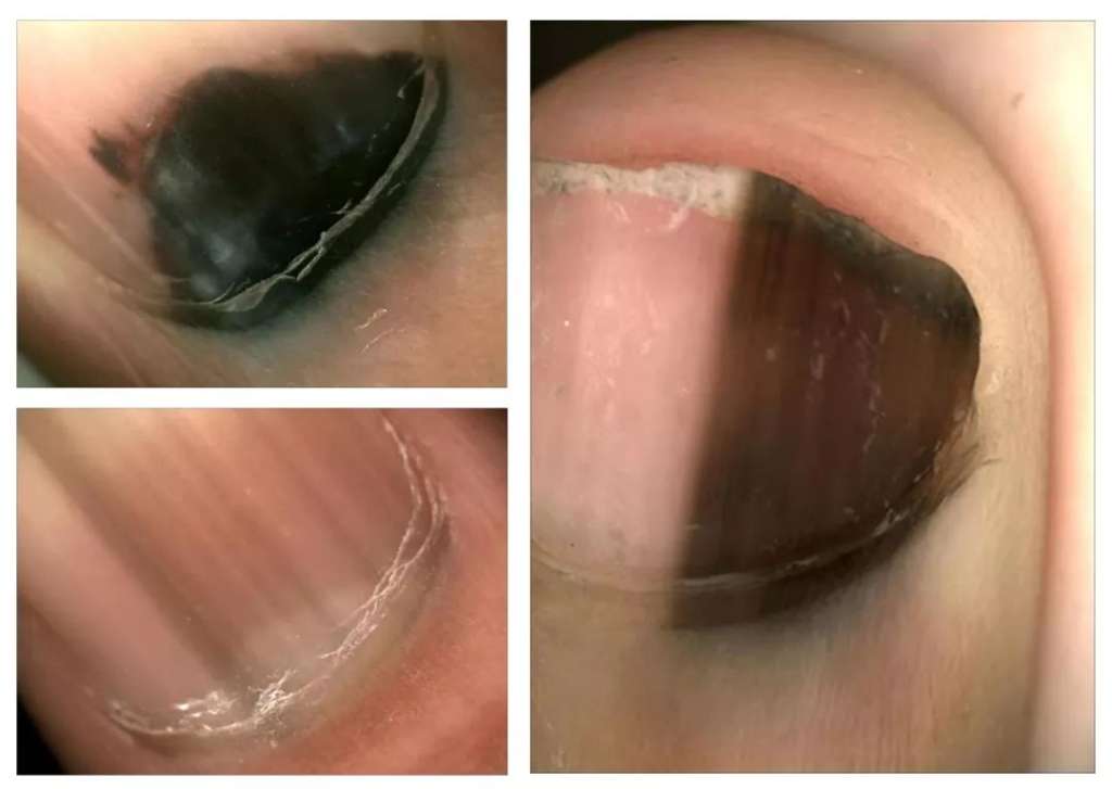 2,甲母痣 甲母痣是痣的一种,其最常见的临床表现就是指甲中出现黑线.